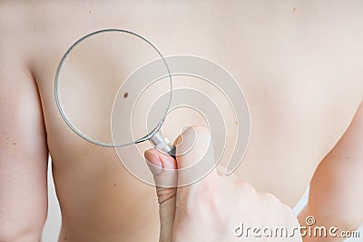 Doctor holds magnifying glass in hand and is examining patient skin for melanoma. Stock Photo