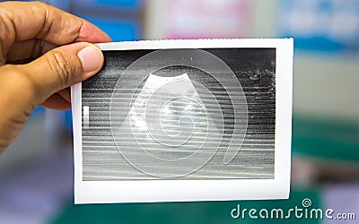 Doctor looking at blurry obstetric ultrasound paper report in antenatal clinic in the hospital. Stock Photo