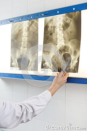 Doctor looking at x-ray photo of pelvis Stock Photo