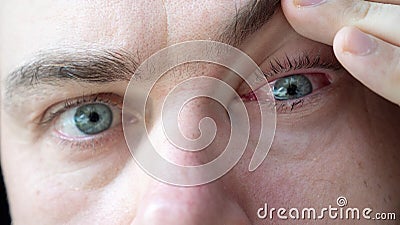 Doctor Looks at Male Patient with Red Inflamed Eyes with Conjunctivitis Stock Photo