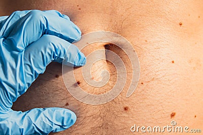 Doctor in medical gloves examining man skin mole. Dermatologist checking male birthmarks. Self care preventing cancer Stock Photo