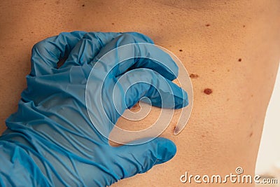 Doctor in medical gloves examining man skin mole. Dermatologist checking male birthmarks. Self care preventing cancer Stock Photo