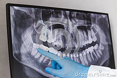Doctor points wisdom tooth in dental x-ray Stock Photo