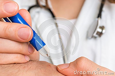 Doctor removing a tick with tweezers from hand of patient Stock Photo