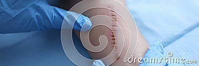 Doctor in rubber protective gloves examining patient scar in clinic closeup Stock Photo