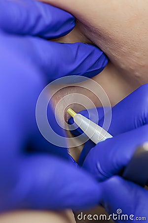 In the doctor`s cosmetology office removes unwanted hairs with the help of electrolysis in the armpit area Stock Photo