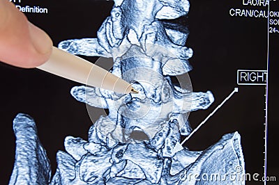 Doctor shows on CT MRI scans place in spine between vertebrae, which is procedure of epidural anesthesia or spinal puncture conduc Stock Photo