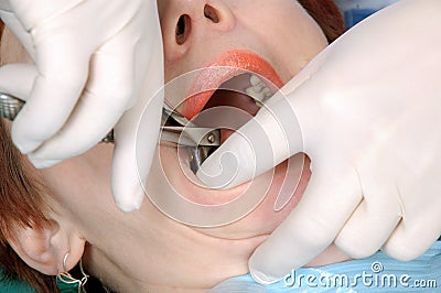 Doctors hands extract a tooth from woman Stock Photo