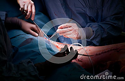 Doctors hands stitching patient leg Stock Photo