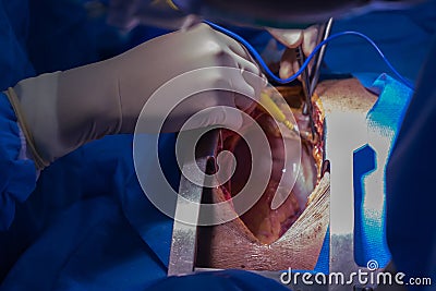 Doctors team perform heart transplant at the operating room in the hospital. Stock Photo