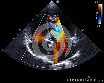 Doppler echocardiography Stock Photo