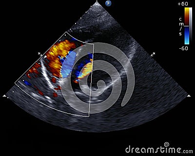 Doppler echocardiography Stock Photo