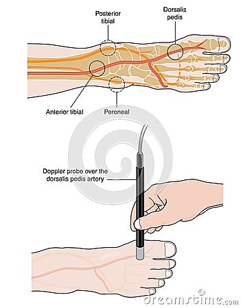 Doppler probe measurement of pedal pulse Vector Illustration