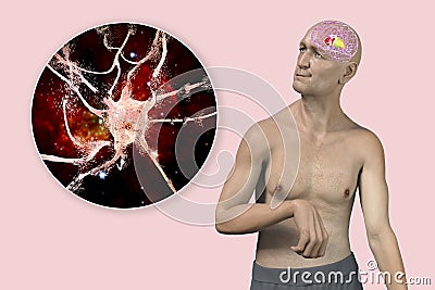 Dorsal striatum, caudate nucleus and putamen, highlighted in the brain of a person with chorea disease and close-up view Cartoon Illustration