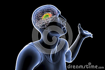 Dorsal striatum highlighted in the brain of a person with chorea disease Cartoon Illustration