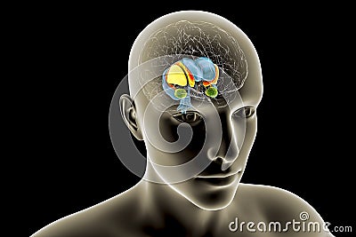 Dorsal striatum and lateral ventricles in the brain of a person with Huntington's disease, 3D illustration Cartoon Illustration