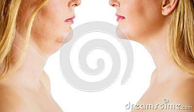 Double chin fat or dewlap correction, before and after Stock Photo