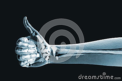 Dramatized x ray of a hand thumbs up Stock Photo