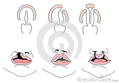 Drawing of cleft palate and cleft lip Vector Illustration