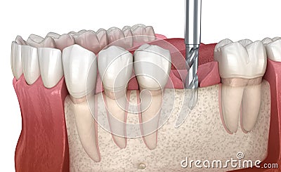 Drilling of the bone for dental implant placement. Medically accurate 3D illustration of human teeth and dentures concept Cartoon Illustration