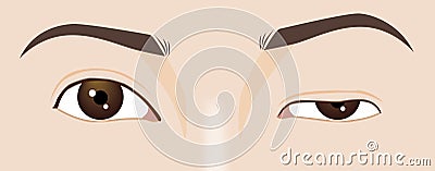 Droopy eyelid ptosis, blepharoplasty symptom, myasthenia gravis, illustration Cartoon Illustration