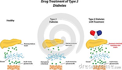 Drug Treatment of Type 2 Diabetes Vector Illustration