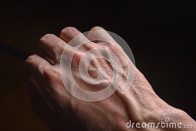 Dry cracked skin of the hand, contact dermatitis, allergies, dryness from frost Stock Photo