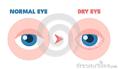 Dry eyes. Healthy unhealthy red eye, driing astonished redness irritated surface eyeball, conjunctivitis glaucoma Vector Illustration