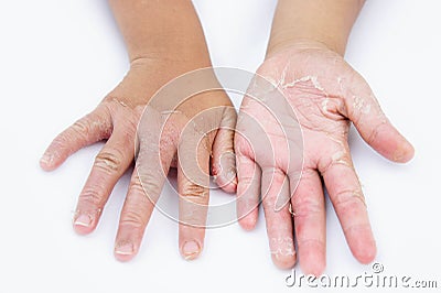 Dry hands, peel, Contact dermatitis, fungal infections, Skin inf Stock Photo