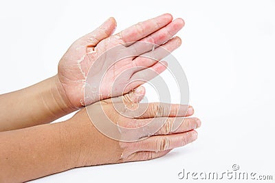 Dry hands, peel, Contact dermatitis, fungal infections, Skin inf Stock Photo