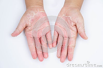 The Dry hands, peel, Contact dermatitis, fungal infections, Skin inf Stock Photo