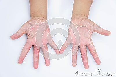 The Dry hands, peel, Contact dermatitis, fungal infections, Skin inf Stock Photo