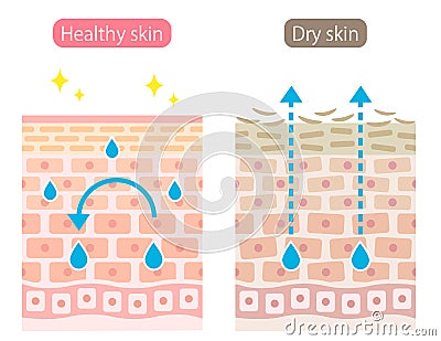 Dry and healthy skin cell layer before after illustration. moisture evaporation from the skin. Beauty and skin care concept Vector Illustration