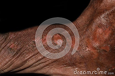 Dry and scaly skin, and abrasions in foot. Dermatitis foot Stock Photo