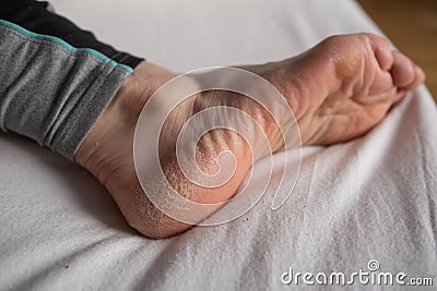 Skin disease in dry winter, dehydrated skin on the heels of female feet Stock Photo