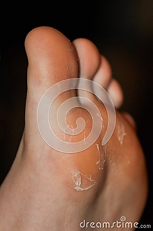 Dry skin of the feet. Stock Photo