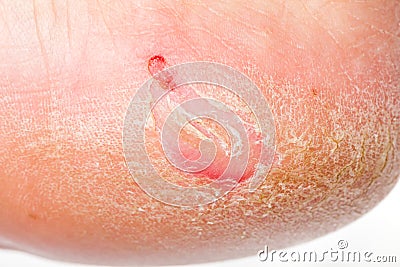 Dry skin on heel Stock Photo