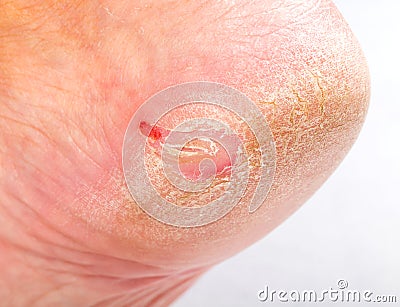 Dry skin on heel Stock Photo