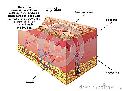 Dry skin Vector Illustration