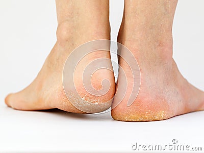 Dry skin, plantar callosity and flakes on female heel and feet sole close up Stock Photo