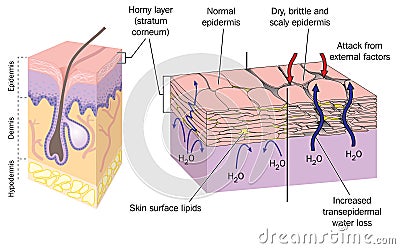 Dry skin Vector Illustration