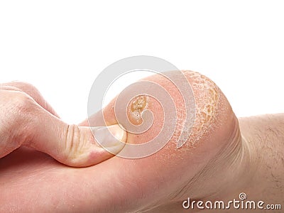 Dry skin under foot Stock Photo