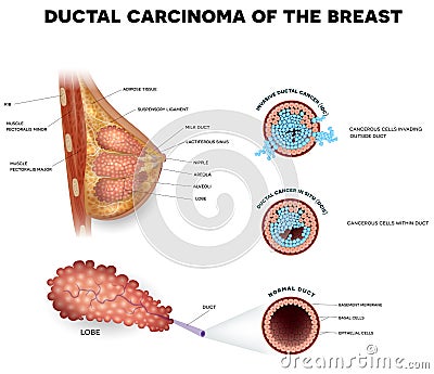 Ductal cancer Vector Illustration