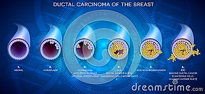 Ductal carcinoma development Vector Illustration