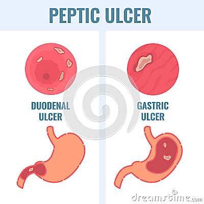 Duodenal and gastric types of peptic ulcer stomach disease Vector Illustration