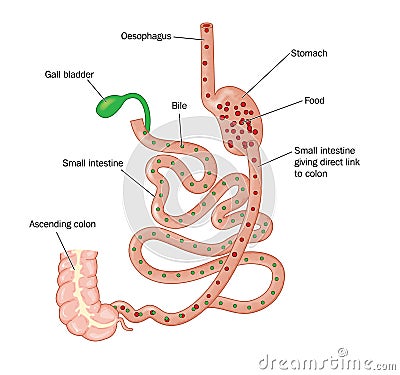 Duodenal switch bariatric surgery Vector Illustration