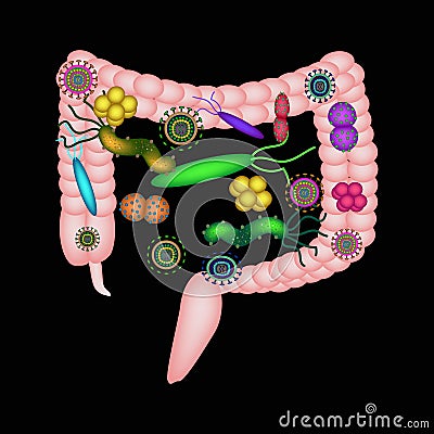 Dysbacteriosis of the intestine. The large intestine. dysbiosis of colon. Bacteria, fungi, viruses. Infographics. Vector Illustration