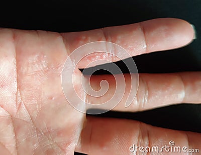 Dyshidrotic Eczema is an allergic skin condition. Stock Photo
