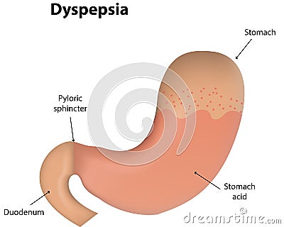 Dyspepsia Vector Illustration