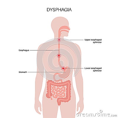 Dysphagia medical poster Vector Illustration